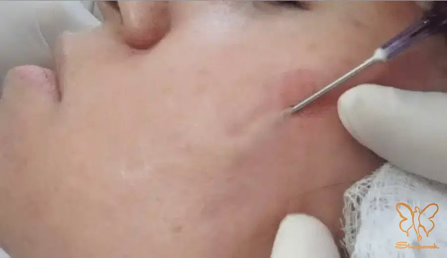 سابسیژن Subcision برای اسکارهای عمیق و چسبنده