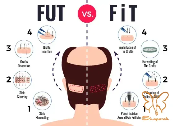هزینه مزایا و معایب کاشت مو FUT در مشهد چیست