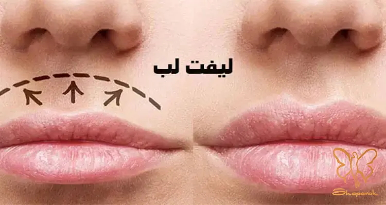 بوتاکس لیفت لب مشهد بوتاکس لیفت لب مشهد