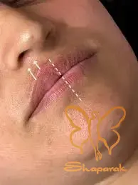 تاثیر بر خطوط بارکدی و ترکیب با سایر روش ها تاثیر بر خطوط بارکدی و ترکیب با سایر روش ها