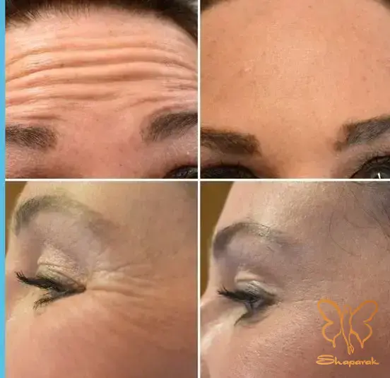 بوتاکس صورت رفع چین و چروک صورت مشهد