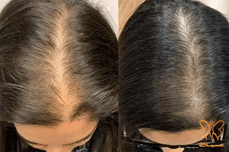  کلینیک تخصصی لیزر موهای زائد شاپرک طلایی در مشهد