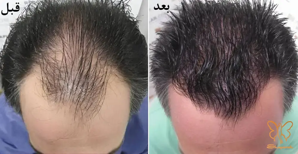 تزریق پی آر پی&nbsp;مو درمان محبوب ریزش مو مشهد