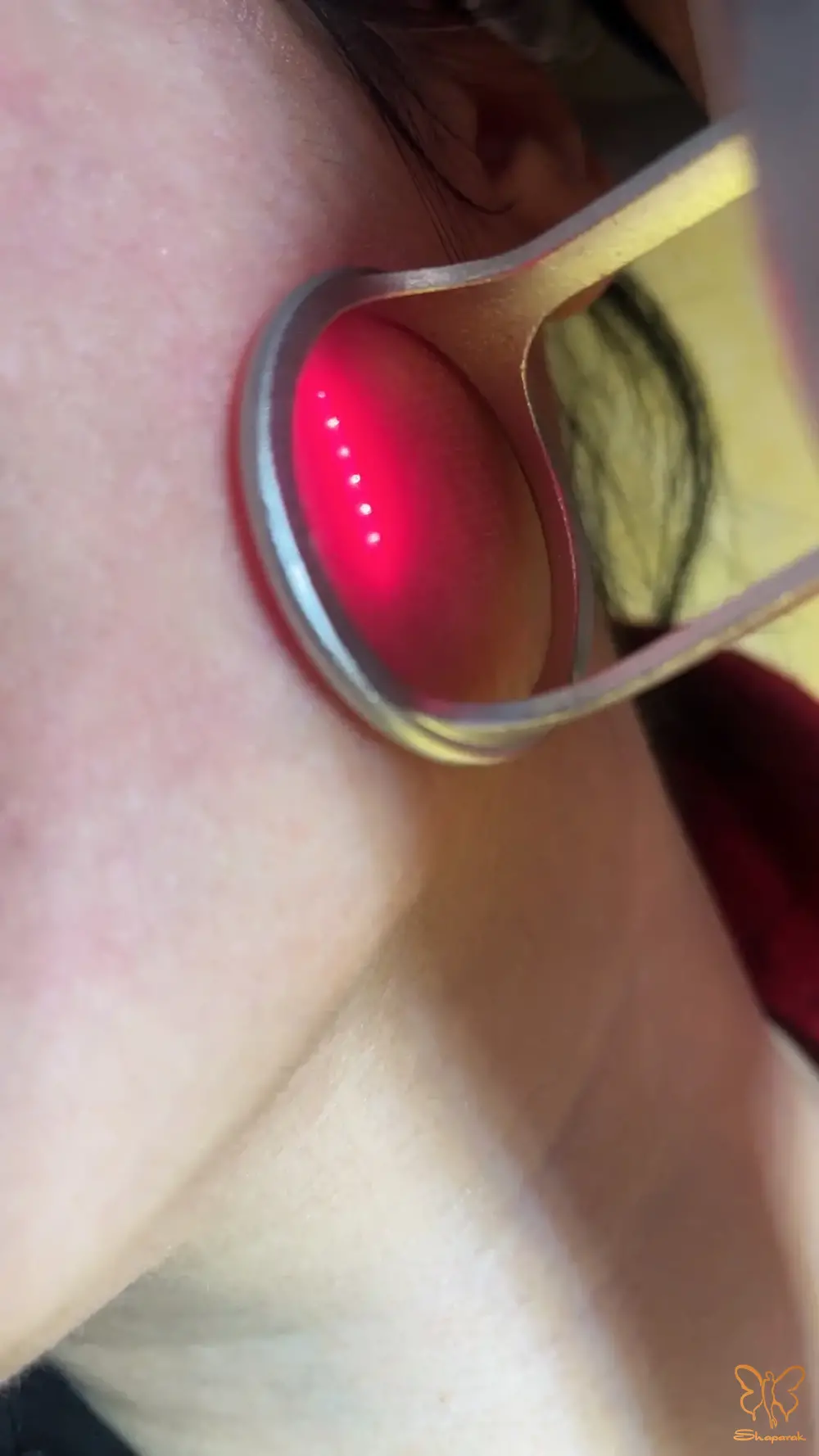 درمان اسکار آکنه