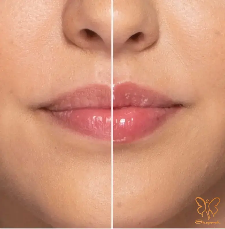 تعداد جلسات مزایا و تفاوتفوتونا حجم دهی لب با تزریق ژل لب تعداد جلسات مزایا و تفاوتفوتونا حجم دهی لب با تزریق ژل لب