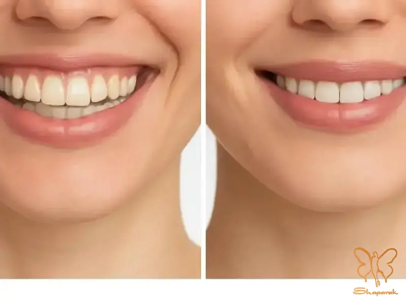 بوتاکس گامی اسمایل لبخند لثه ای مشهد بوتاکس گامی اسمایل لبخند لثه ای مشهد