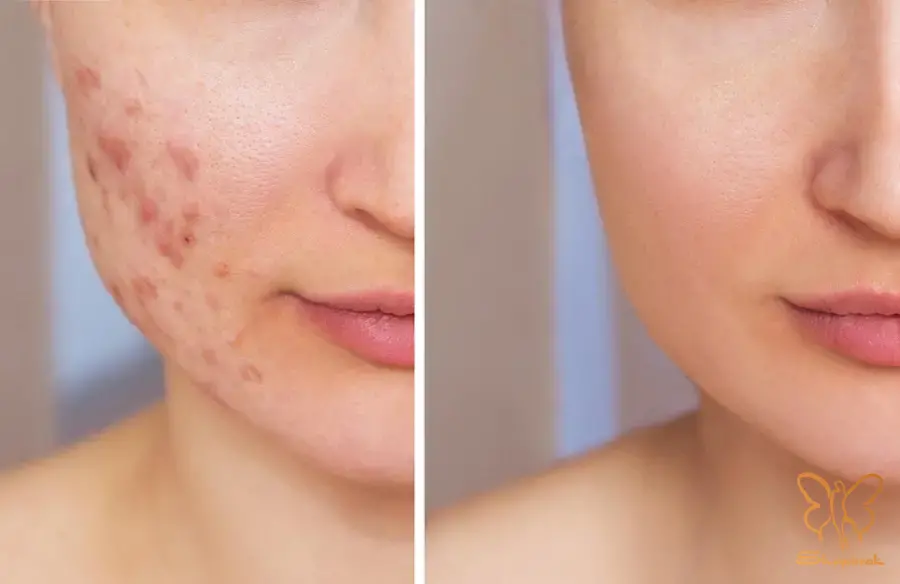 دوره درمان و نقاهت مسیر شفافیت پوست چقدر طول می کشد دوره درمان و نقاهت مسیر شفافیت پوست چقدر طول می کشد