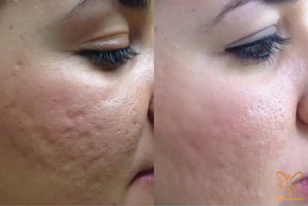 تزریق چربی صورت مشهد تزریق چربی صورت مشهد