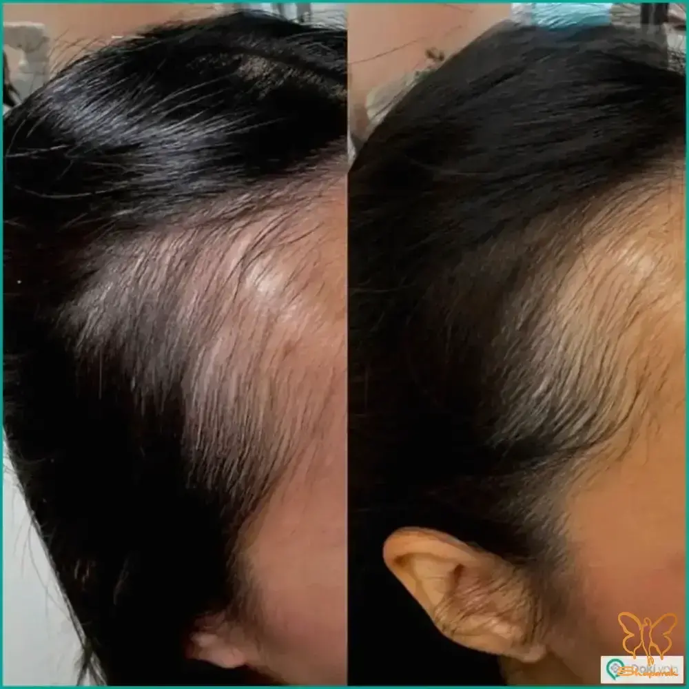 مزوتراپی مو درمان موثر برای ریزش مو مشهد