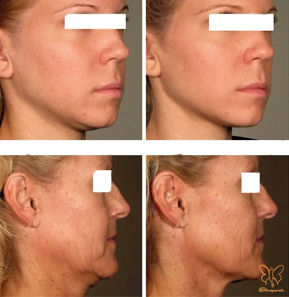 معجزه یک جلسه ای و ماندگاری هایفوتراپی در کلینیک شاپرک مشهد معجزه یک جلسه ای و ماندگاری هایفوتراپی در کلینیک شاپرک مشهد