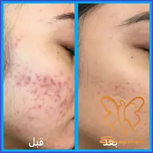دستگاه فوتونا فرکشنال پوست مشهد دستگاه فوتونا فرکشنال پوست مشهد