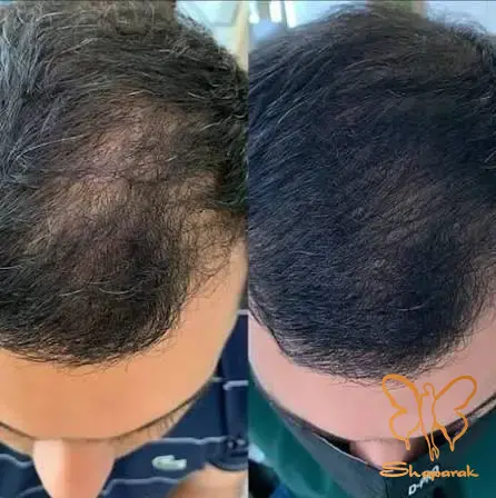 پلاسمایی با غلظت بالای فاکتورهای رشد پلاسمایی با غلظت بالای فاکتورهای رشد