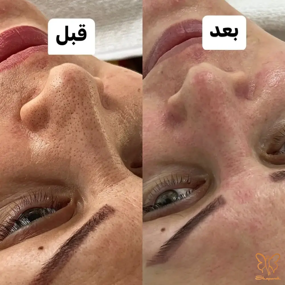 کدری و خستگی پوست 