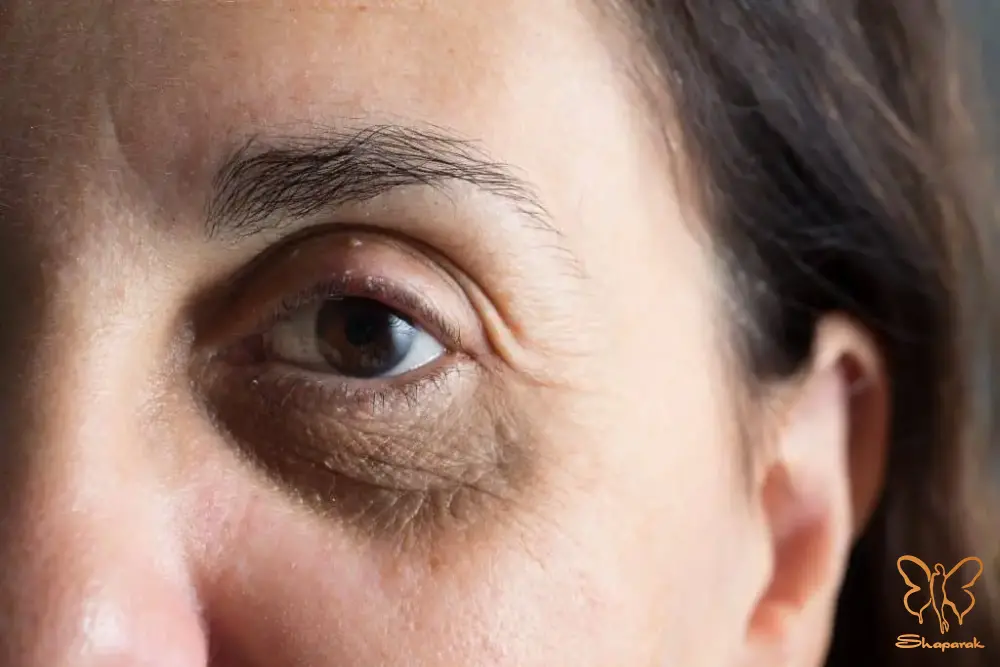 علت تیرگی زیر چشم در زنان و بررسی آن در کلینیک شاپرک مشهد
