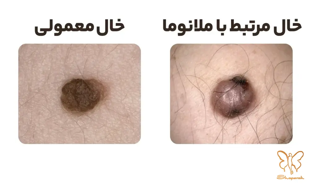 چرا تشخیص زودهنگام ملانوما حیاتی است