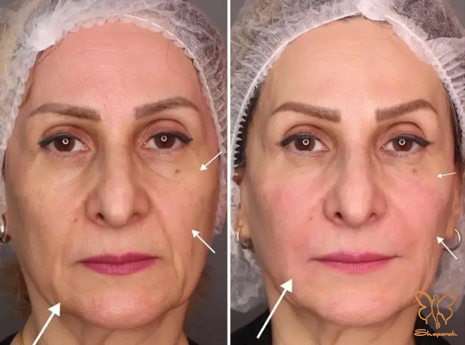 نیوویا Neauvia نیوویا Neauvia