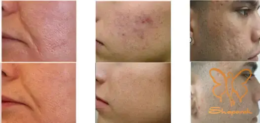 هایفوتراپی HIFU صورت و گردن در مشهد