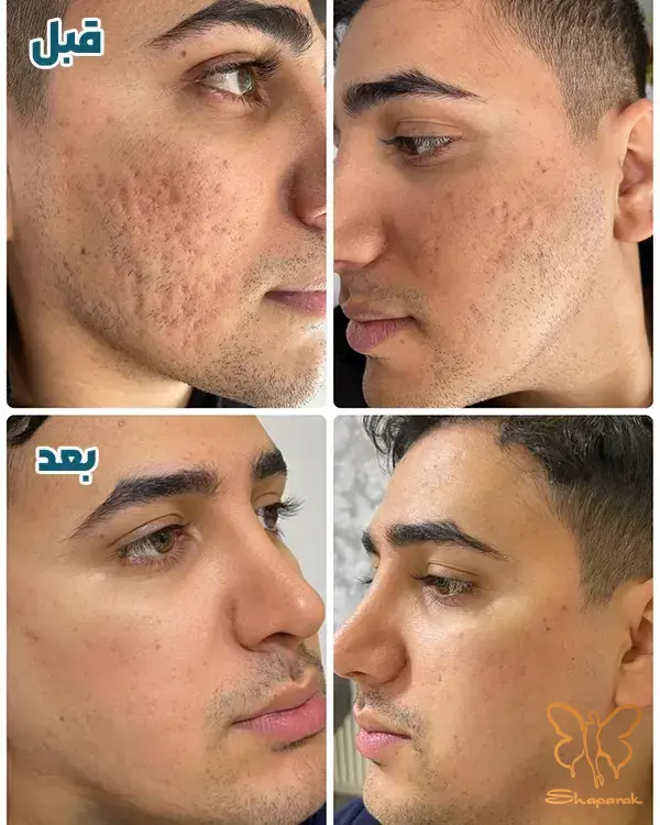 پیگمانتاسیون