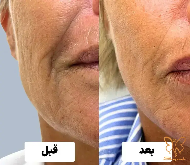  مزوژل جالپرو صورتی در مشهد یا Jalupro HMW 