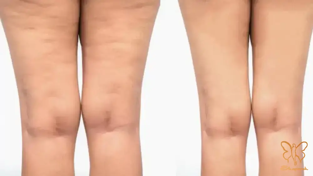 چرا تشخیص نوع سلولیت در کلینیک شاپرک طلایی حیاتی است چرا تشخیص نوع سلولیت در کلینیک شاپرک طلایی حیاتی است