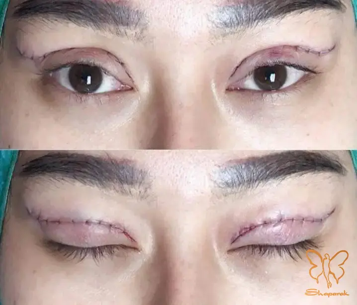 آیا این ورم چشم&nbsp;دائمی است