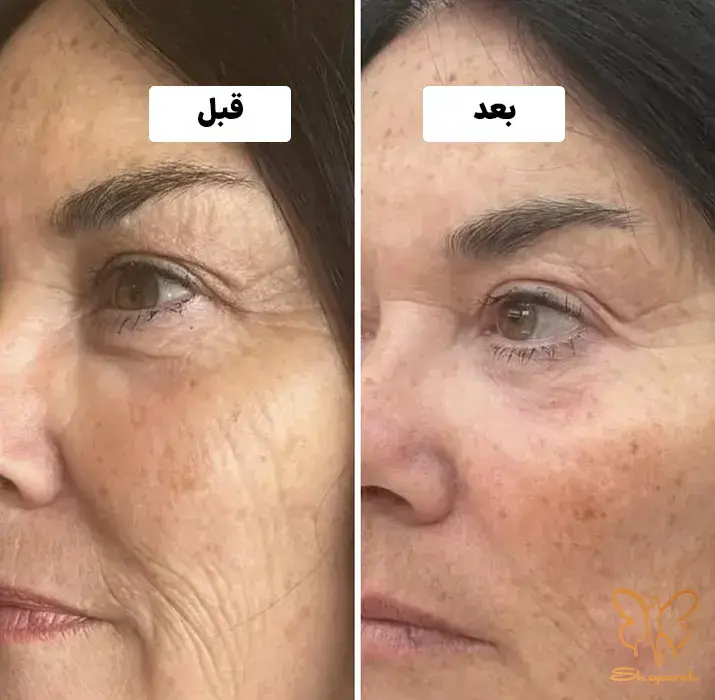 مزوژل جالپرو سوپرهیدرو در مشهد Jalupro SuperHydro