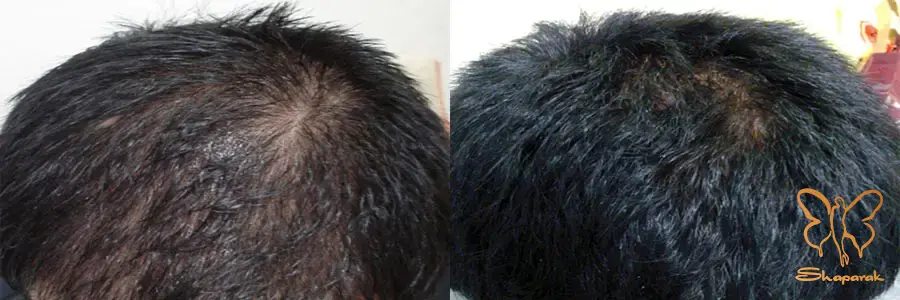 پی آرپی صورت مشهد