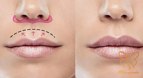 لیفت سانترال لب راه حلی دائمی برای لب های برجسته تر لیفت سانترال لب راه حلی دائمی برای لب های برجسته تر