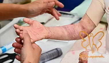 انواع مختلف بیماری پروانه ای و شدت آن انواع مختلف بیماری پروانه ای و شدت آن