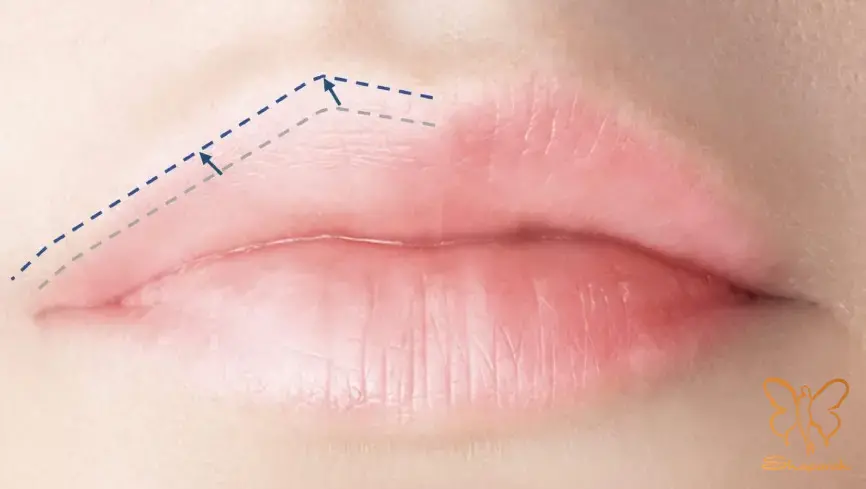 تزریق بوتاکس لب مشهد تزریق بوتاکس لب مشهد