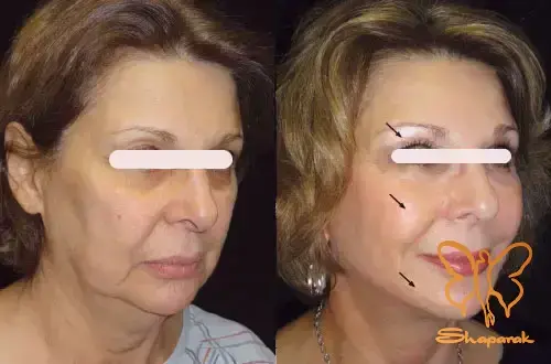 نخ های غیرکاگ صورت مشهد