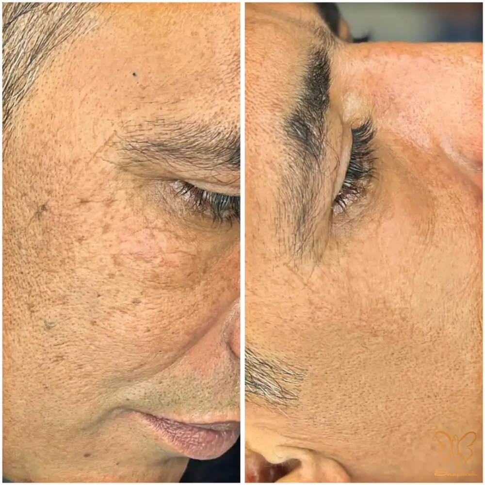 رفع ترک های پوستی استریا 