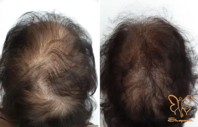 کلینیک تخصصی لیزر موهای زائد شاپرک طلایی مشهد کلینیک تخصصی لیزر موهای زائد شاپرک طلایی مشهد