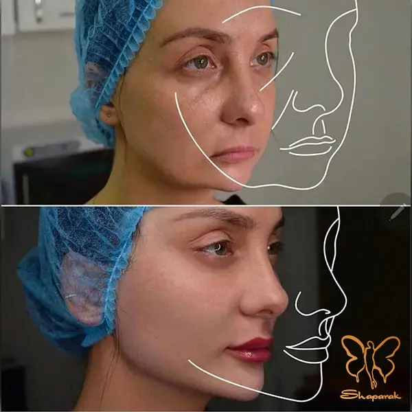 تاثیر تزریق ژل چانه در کلینیک شاپرک مشهد زیبایی و تعادل صورت تاثیر تزریق ژل چانه در کلینیک شاپرک مشهد زیبایی و تعادل صورت