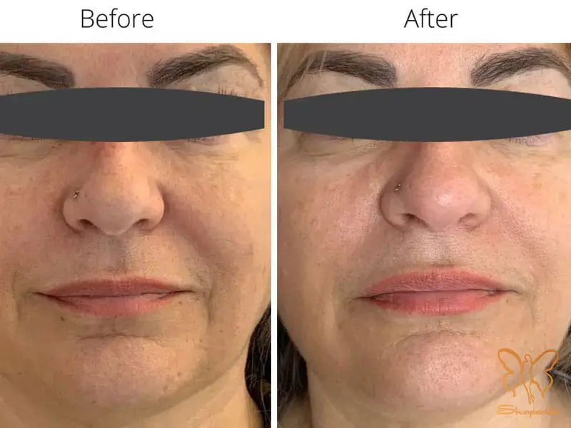 مزوژل های جوانساز مشهد مزوژل های جوانساز مشهد