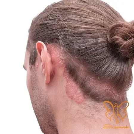 CO2 فرکشنال CO2 فرکشنال