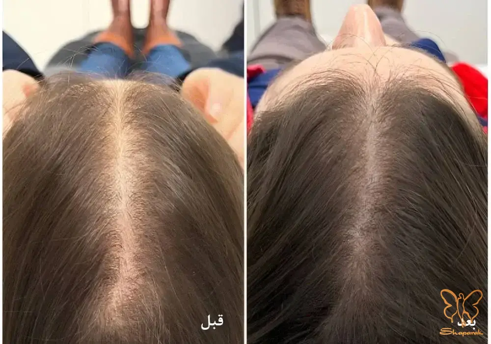 کاربردها و مزایای شگفتانگیز هیر فیلر در مشهد تقویت و تحریک رشد مو