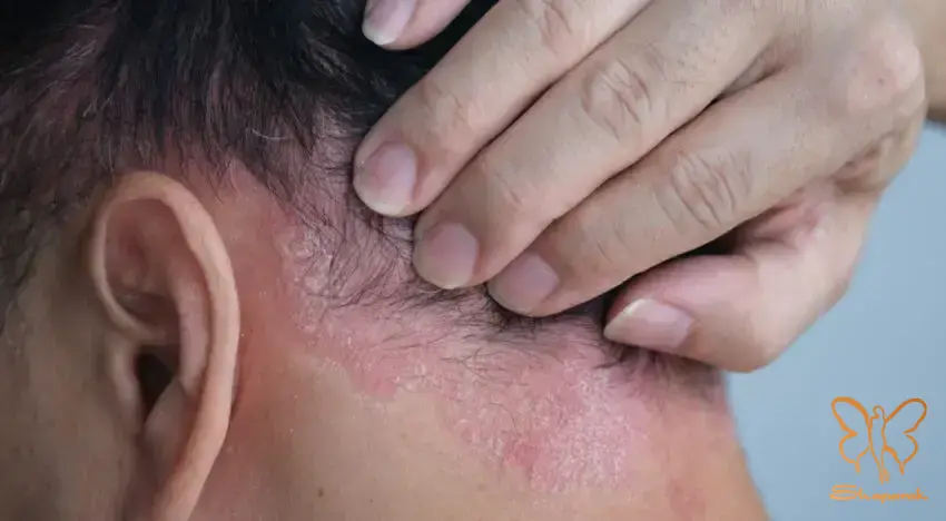 علائم کلیدی درماتیت سبورئیک پوستی که باید آن ها را بیشتر بشناسید علائم کلیدی درماتیت سبورئیک پوستی که باید آن ها را بیشتر بشناسید