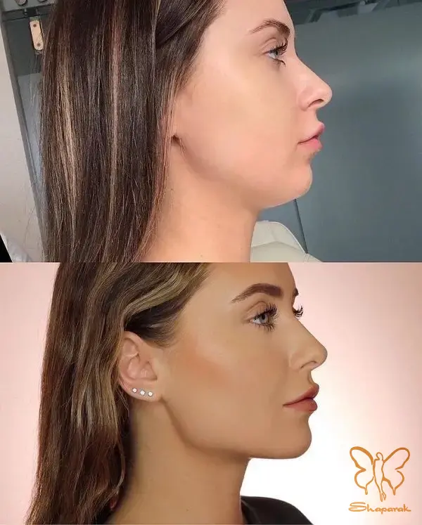 کاندیدای مناسب و نا مناسب برای تزریق ژل چانه کاندیدای مناسب و نا مناسب برای تزریق ژل چانه