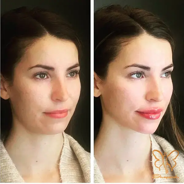 ژل پلوریال Pluryal ژل پلوریال Pluryal