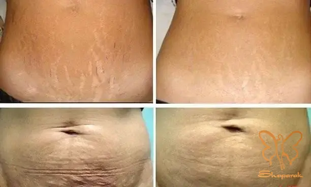 کاهش ترکهای پوستی استرچ مارک