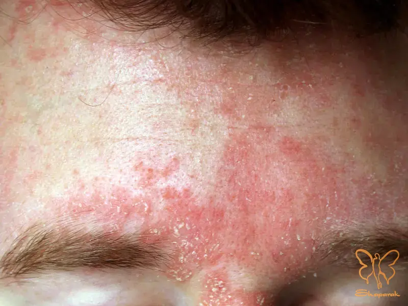 آیا درماتیت سبورئیک درمان قطعی دارد جواب در کلینیک شاپرک مشهد آیا درماتیت سبورئیک درمان قطعی دارد جواب در کلینیک شاپرک مشهد