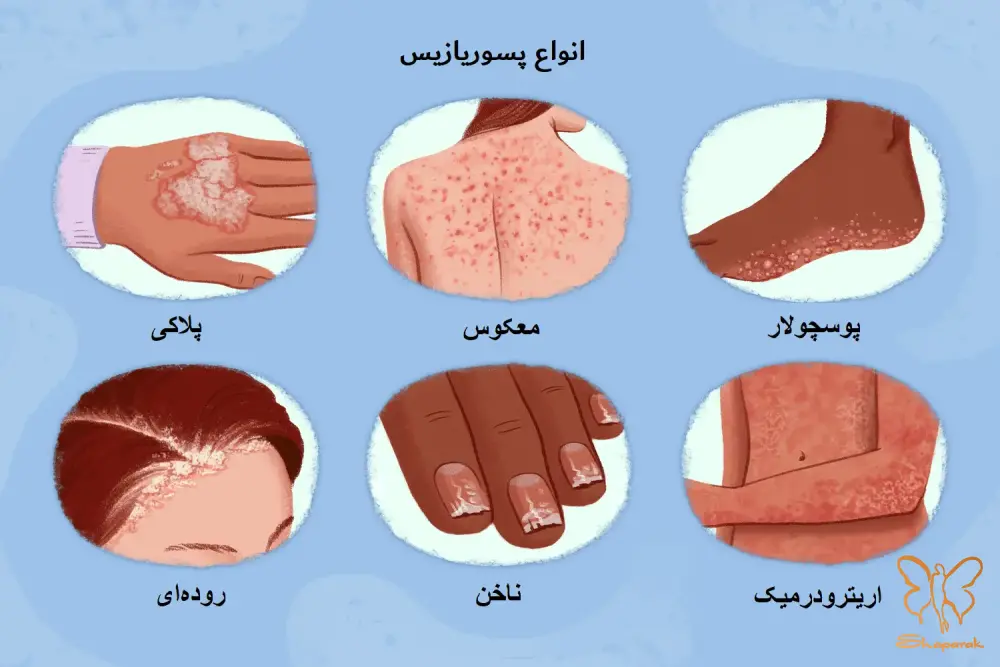 بررسی انواع مختلف پسوریازیس و شدت بیماری در کلینیک شاپرک مشهد 