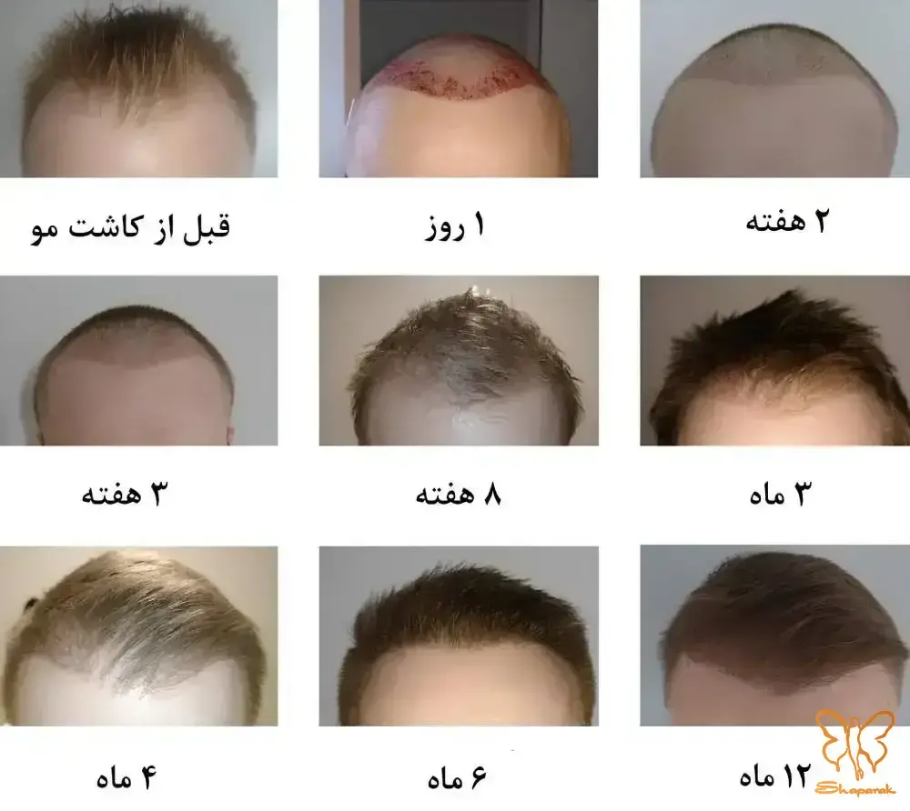 کاشت مو به روش FUT در مشهد&nbsp;