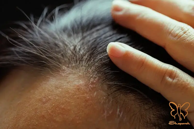 کلینیک تخصصی پوست و مو شاپرک طلایی مشهد کلینیک تخصصی پوست و مو شاپرک طلایی مشهد