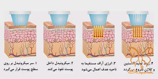 لیفت و جوانسازی پوست