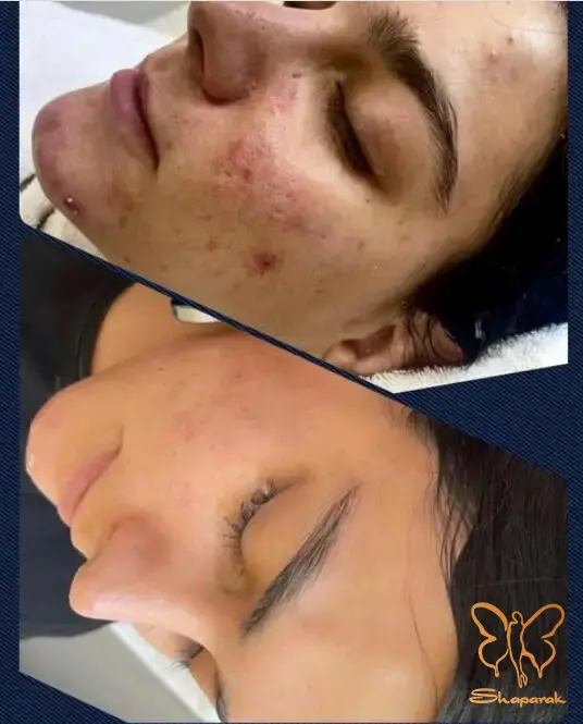پاکسازی های تخصصی در مشهد معجزه داشتن پوستی با کیفیت
