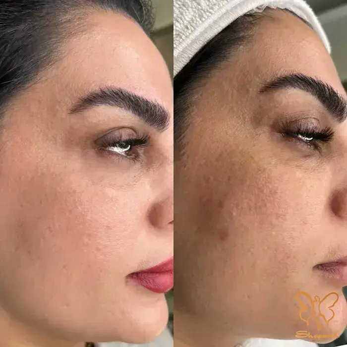 حتما باید با احتیاط زیاد عمق نفوذ کم به پوست و در جلسات متعدد انجام شود حتما باید با احتیاط زیاد عمق نفوذ کم به پوست و در جلسات متعدد انجام شود
