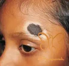 درمان لک سفید باقیمانده از خال هاله دار