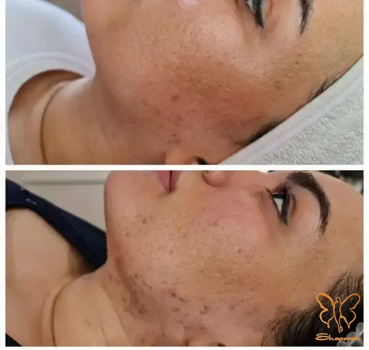  کلینیک تخصصی لیزر موهای زائد شاپرک طلایی در مشهد